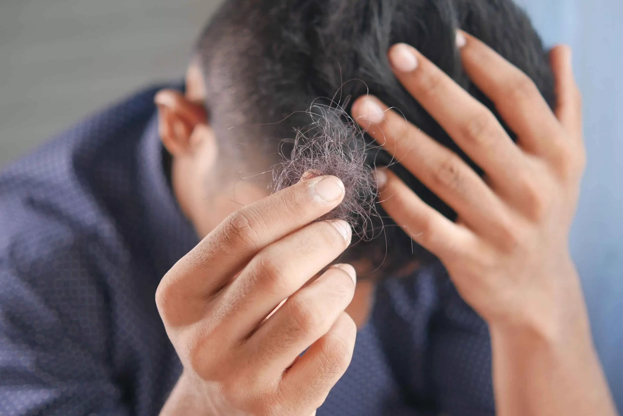 La caída del cabello en hombres y mujeres